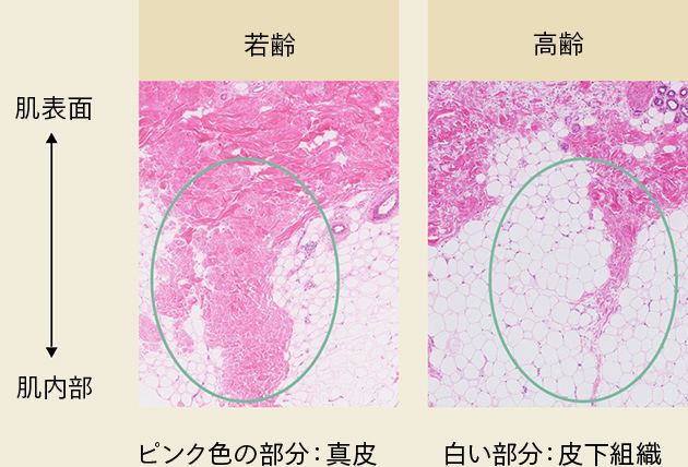 若齢と高齢の肌表面・肌内部の比較。ピンク色の部分は真皮 白い部分は皮下脂肪。加齢に伴い汗腺の位置が上昇し、汗腺の委縮した部位が皮下脂肪に置き換わり空洞化。