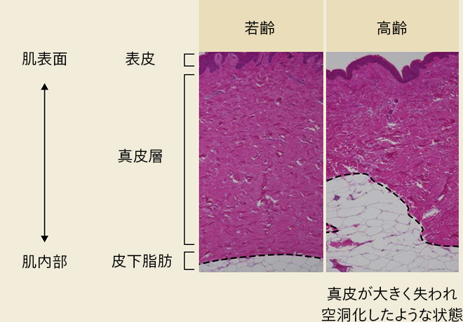 若齢と高齢の肌の真皮下部組織の比較。若齢は真皮が密に詰まっている。高齢は真皮が失われ空洞化したような状態。